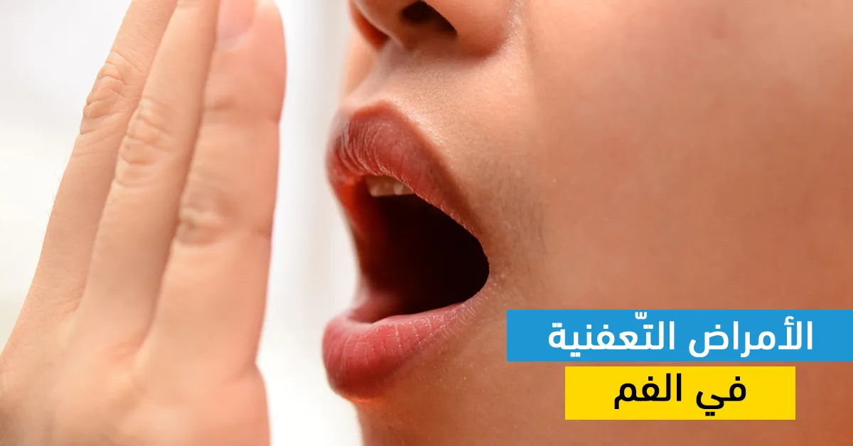 الأمراض التّعفنية في الفم